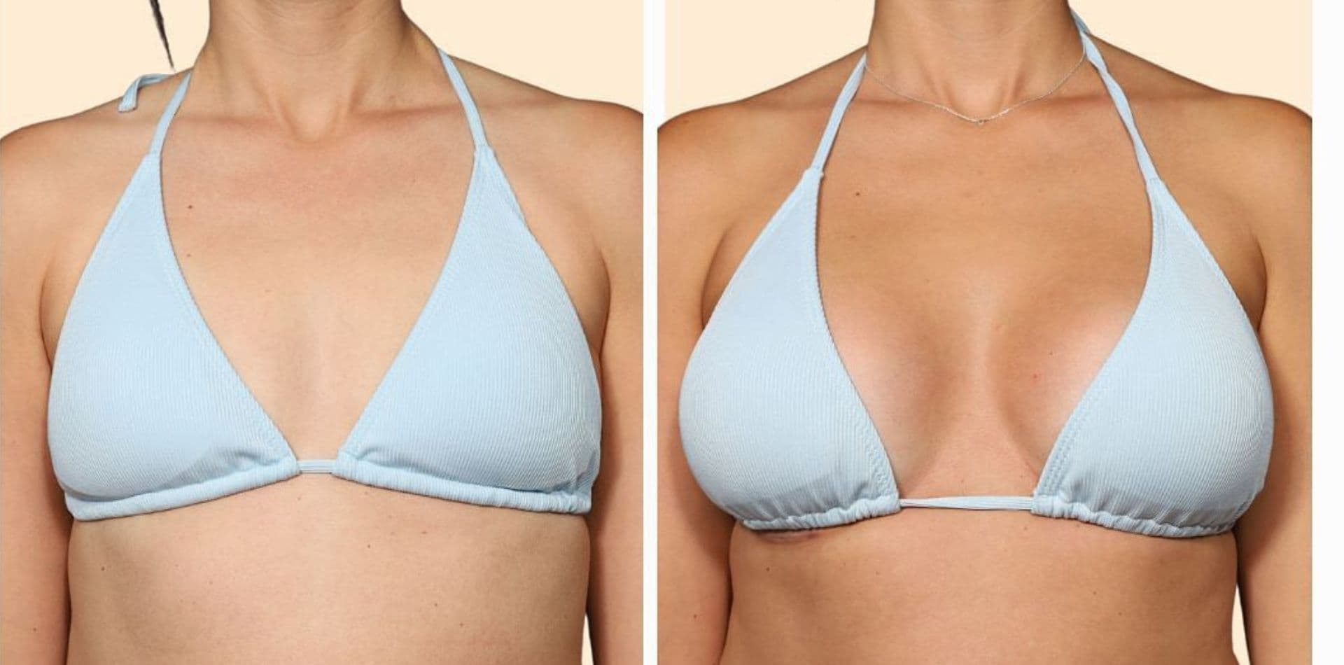 Breast Implant — Paradise Polyclinic