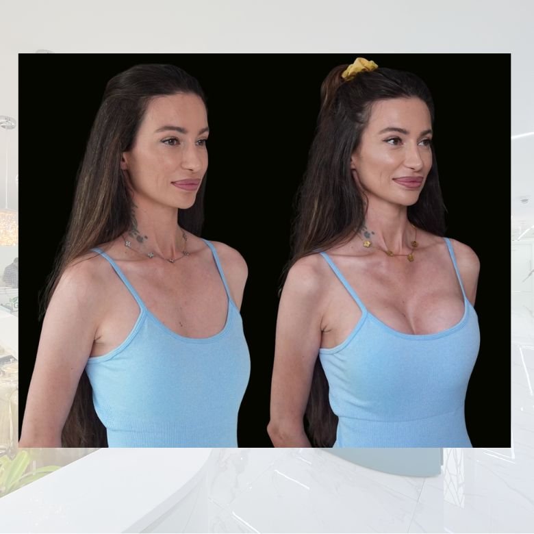 Breast augmentation 