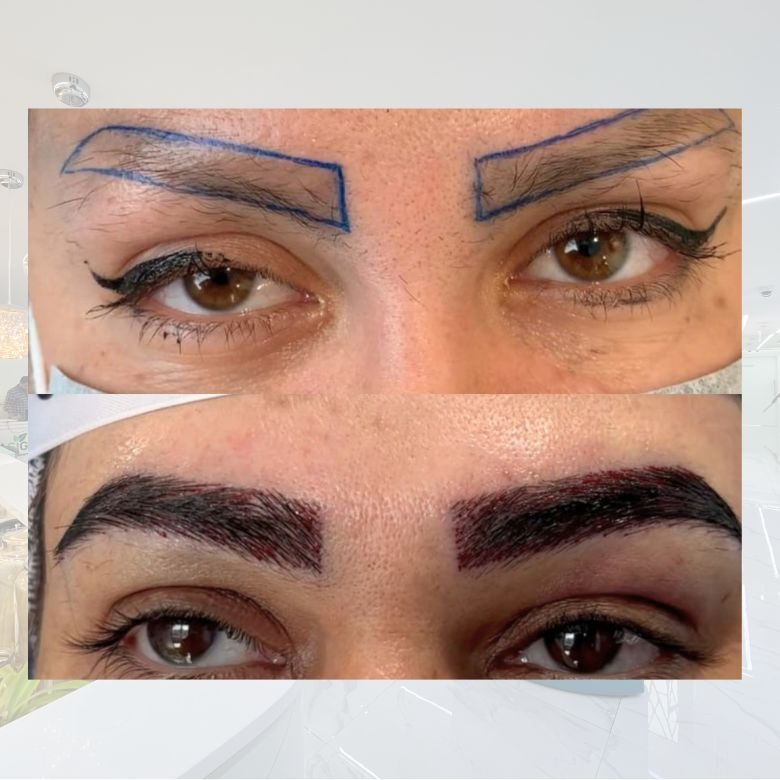 Eyebrow Restoration