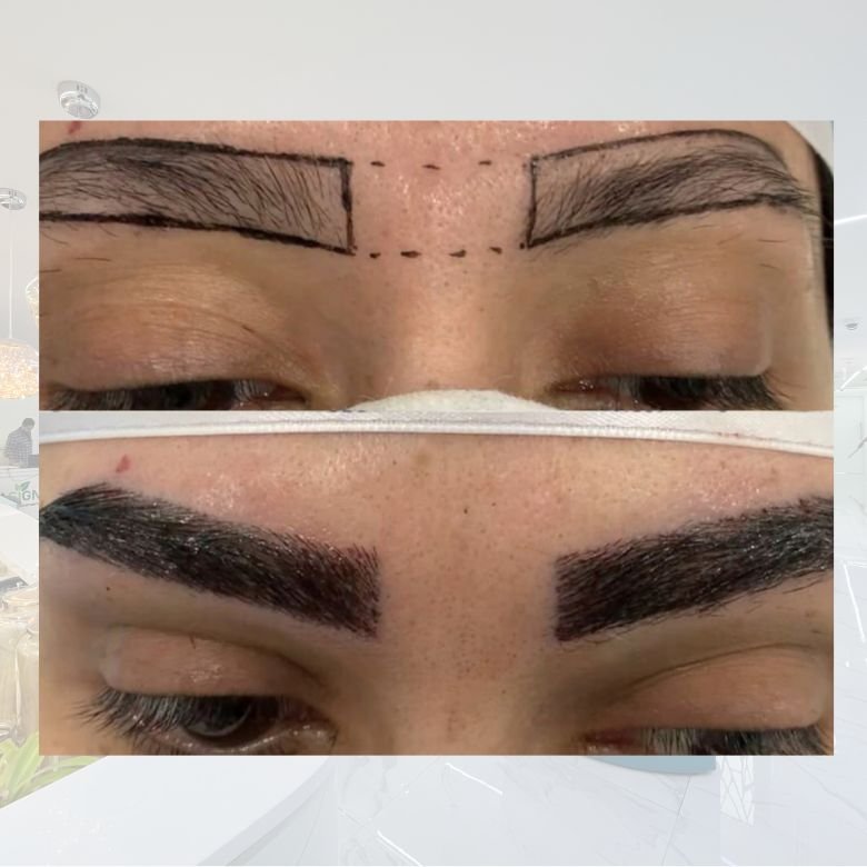 Eyebrow Restoration