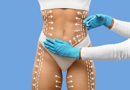 Liposuction (Tummy, Legs, Arms)