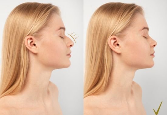 Rhinoplasty